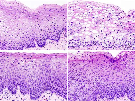 Cervix Transformation Zone Histology