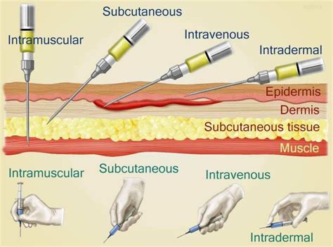 Intravenous Injection Sites