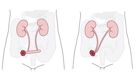 What is a Stoma? Stoma Function and Types Explained