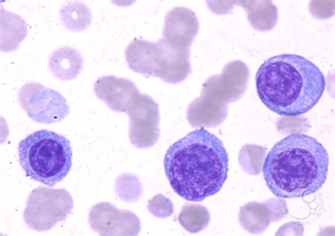 Plasma Cell Leukemia - 3.