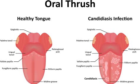 Oral Candida – Symptoms and Treatments You Need to Know! - Dental Aware Australia