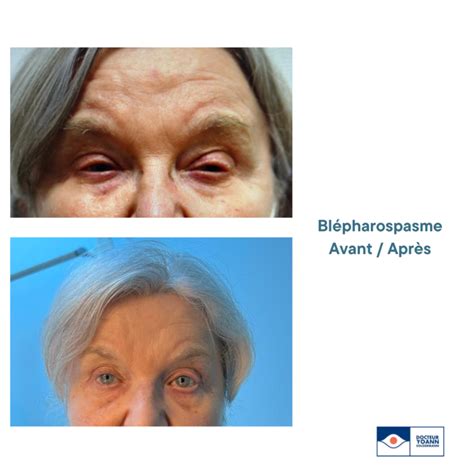 Le blépharospasme - Chirurgie Paupière