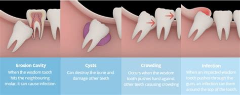 Wisdom Tooth Extraction 6 Facts You Need To Know - Riset