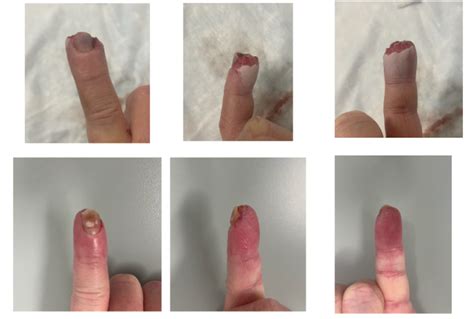 Finger Tip Amputation Treatment - Raleigh Hand Surgeon