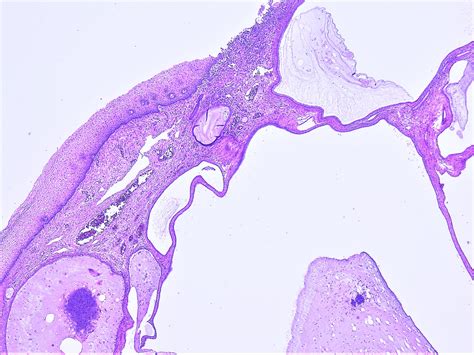 Pathology Walker@Auto Tweet Bot on Twitter: "Nabothian cyst of uterine cervix. Uterus ...