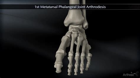 Metatarsal Phalangeal Joint Anatomy | Hot Sex Picture