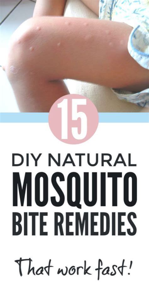 Insect bite relief - fast DIY remedies for mosquito bites that stop itching fast. These natural ...