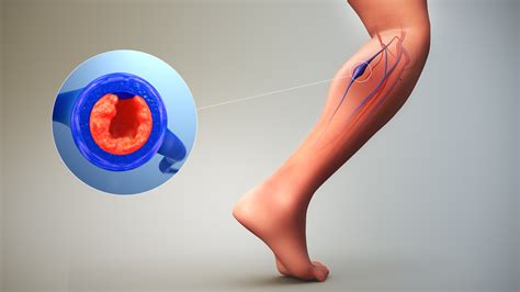 Deep Vein Thrombosis (DVT): Symptoms, Causes, and Treatment