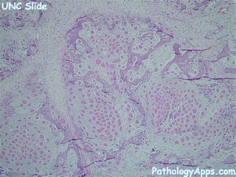 myositis ossificans pathology