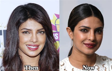 Priyanka Chopra Plastic Surgery Before and After Photos - Latest ...