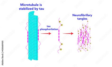 Neurofibrillary tangles [Tau proteins] microtubule Stock Vector | Adobe Stock