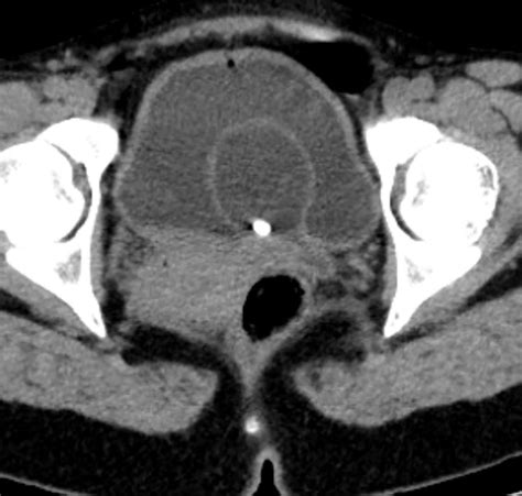 -Axial noncontrast CT of the pelvis shows left ureterocele with ...