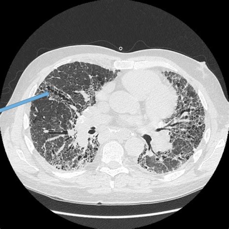 Radiology - Bronchiectasis