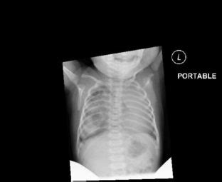 Congenital Cystic Adenomatoid Malformation - Cancer Therapy Advisor