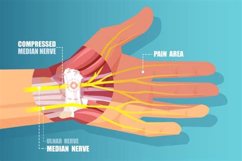 How Carpal Tunnel is Treated? - Dr. Naveen Bhadauria | Private ...