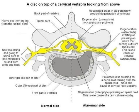 Cervical Radiculopathy - Physiopedia | Radiculopathy, Cervical spondylosis, Cervical radiculopathy