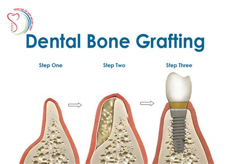 Advantages and disadvantages of materials used for bone graft