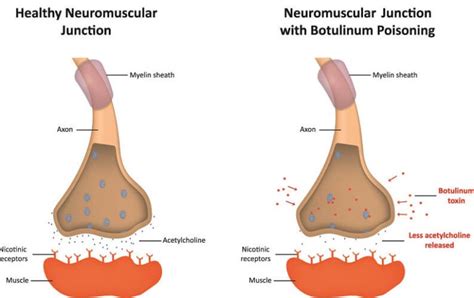 Botulinum Toxin - The Definitive Guide | Biology Dictionary