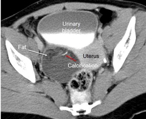 Ovarian Cyst On Ct Scan