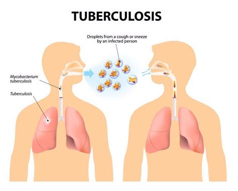 What are the signs and symptoms of TB?