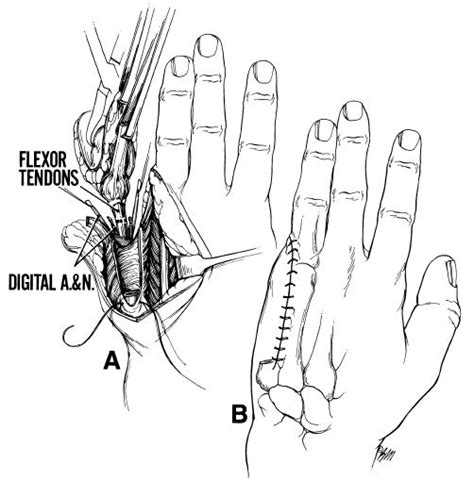 hand - Fifth ray amputation/resection - what does rehabilitation look like? - Medical Sciences ...