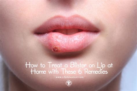 How to Treat a Blister on Lip at Home with These 5 Remedies