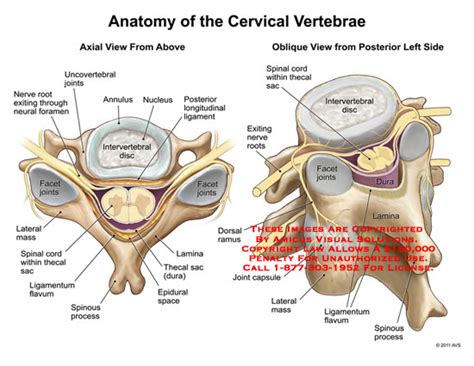 Cervical Thecal Sac submited images.