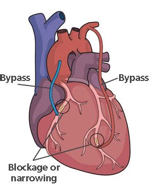 What is cabg surgery