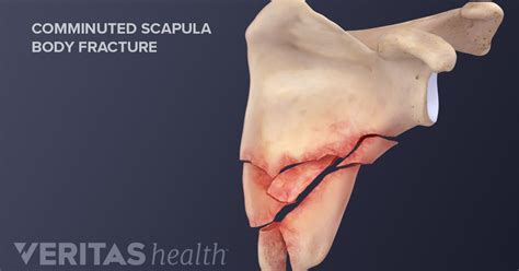 A Broken Shoulder: Scapula Fracture