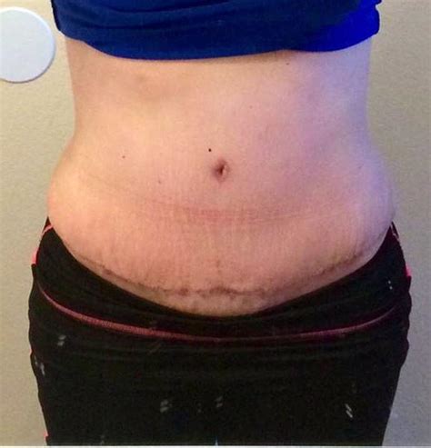 Tummy tuck scars photos after recovery » Tummy Tuck: Prices, Photos, Reviews, Info, Q&A