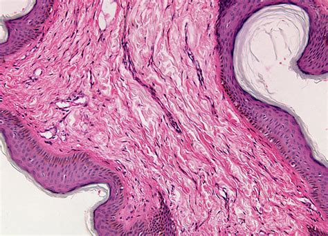 Squamous Cell Papilloma at 10x Magnification | Nikon’s MicroscopyU