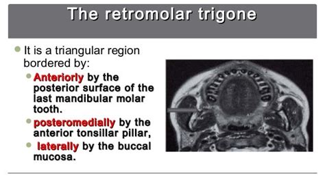 Retromolar Trigone Anatomy