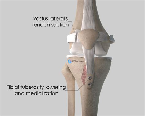 Tibial Tubercle Osteotomy