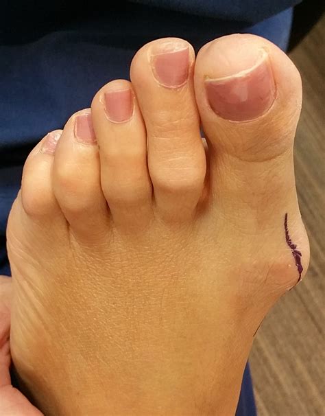 Surgical Correction of Bunions | Podiatric Surgery Centre