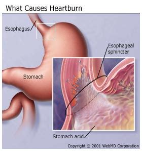 heartburn Archives - Rose City AcupunctureRose City Acupuncture