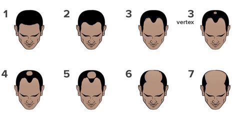 The Norwood Scale - 7 Stages of Hair Loss | The Bald Company