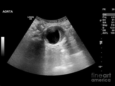 Abdominal Aorta Ultrasound