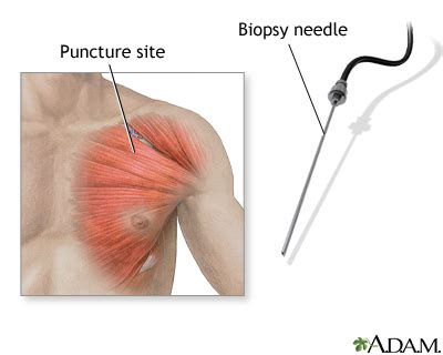 Muscle biopsy | UF Health, University of Florida Health