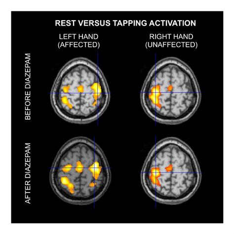 Brain activation maps obtained by the analysis of fMRI scans, showing ...