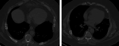 High‐resolution chest CT with evident fractures of costal arches ...