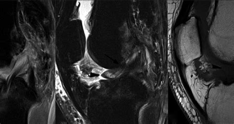 What is Arthrofibrosis of the knee?, Kensington Physio & Sports Medicine