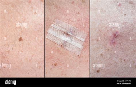 Dermatofibroma Removal Scar Pictures