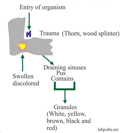 Mycetoma Diagnosis and Causative Agents - Labpedia.net