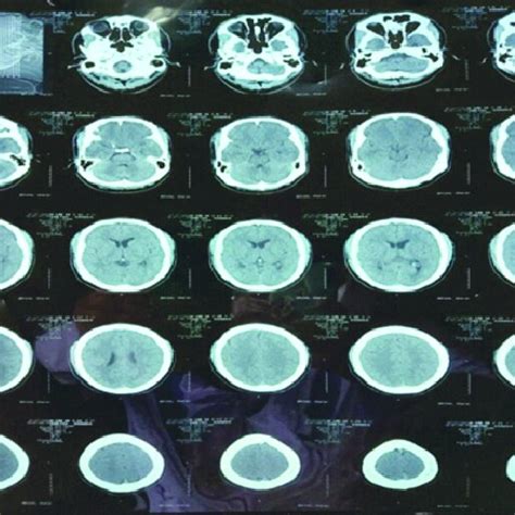 Figure1: NCCT head of the paent showing normal scan. | Download Scientific Diagram