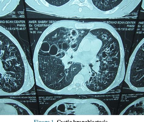 Figure 1 from Impact of Cystic versus Cylindrical Types of Bronchiectasis on Pulmonary and ...