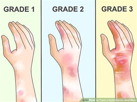 4 Ways to Treat a Hydrofluoric Acid Burn - wikiHow