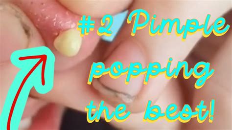 Pimple popping satisfying compilation, the best of! #2 - YouTube