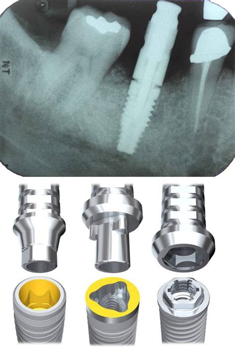 Connecting your impression coping to the implant