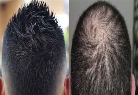 How to Regrow Hair on Bald Head: 10 Powerful Natural Solutions