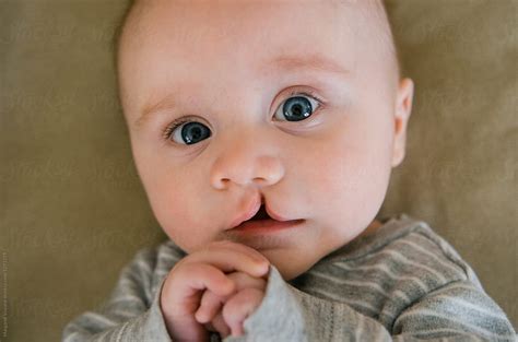 All about Cleft Lip and Palate: What You Should Expect and Know